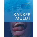 Kanker Mulut